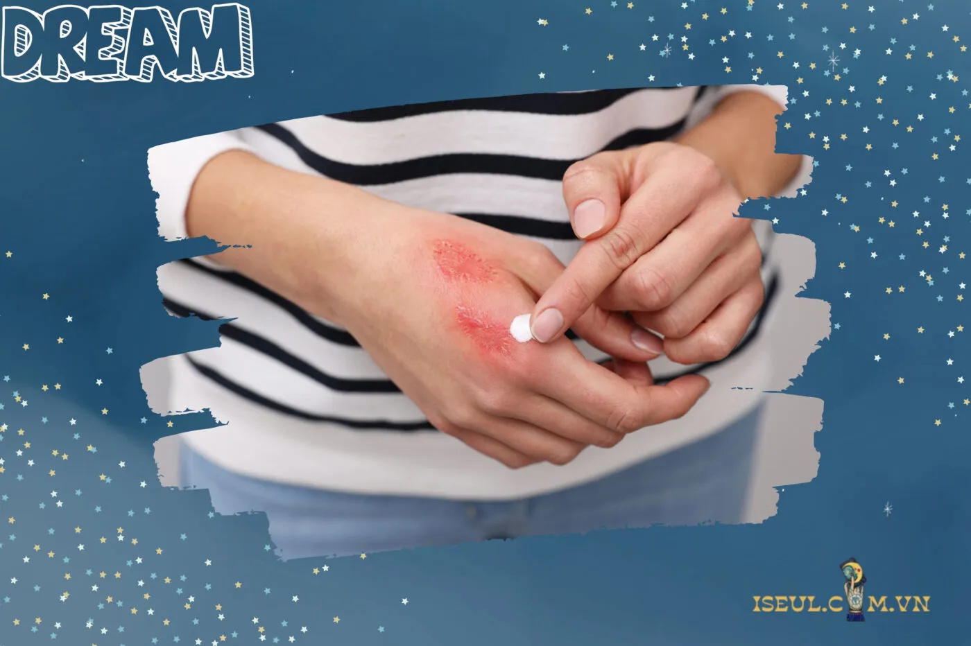 Mơ thấy bị bỏng và các con số liên quan