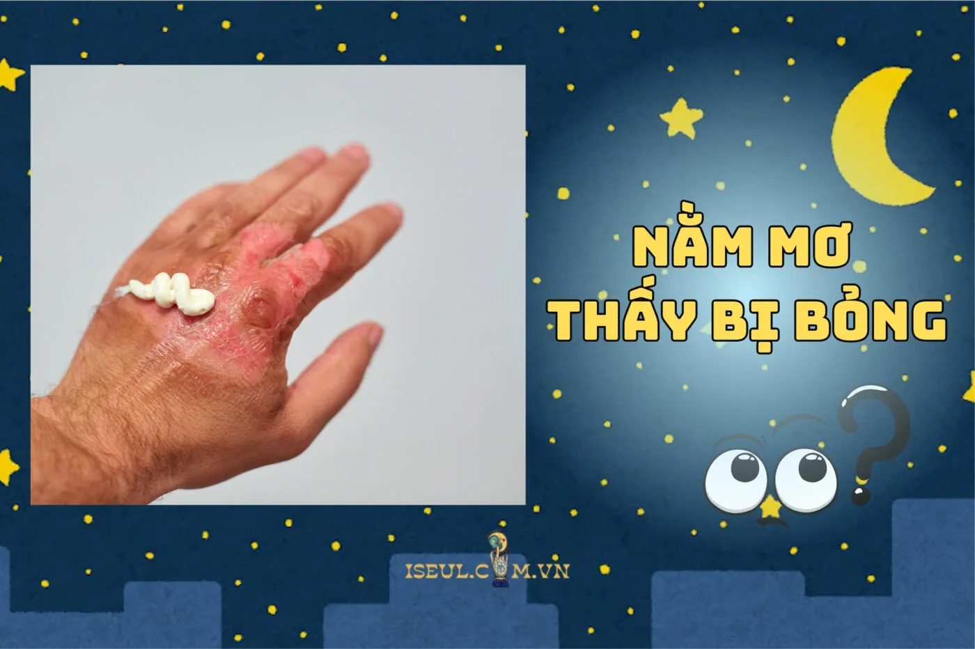 Nằm mơ thấy bị bỏng: Điềm gở hay tín hiệu may mắn 2025